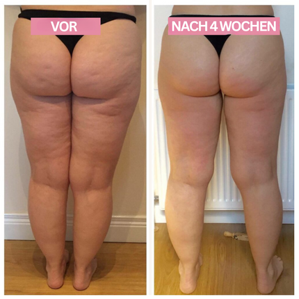 SkinLift™ Cupping-apparaat voor Thuisgebruik | Verstevig je huid en stimuleer de doorbloeding in minuten