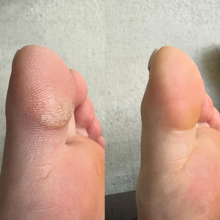 SmoothFeet™ Elektrische Voetvijl | Verwijder eelt snel en geniet van zijdezachte voeten