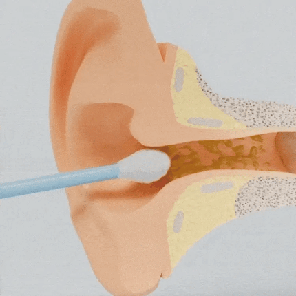 EarClean Pro™ Oorreiniger met Camera | Veilig en nauwkeurig oorsmeer verwijderen met zicht